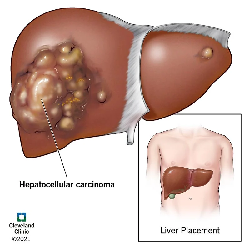 Liver Tumors